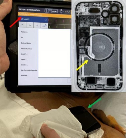 iPhone 12可逼停心脏除颤器 磁场超安全阈值30倍